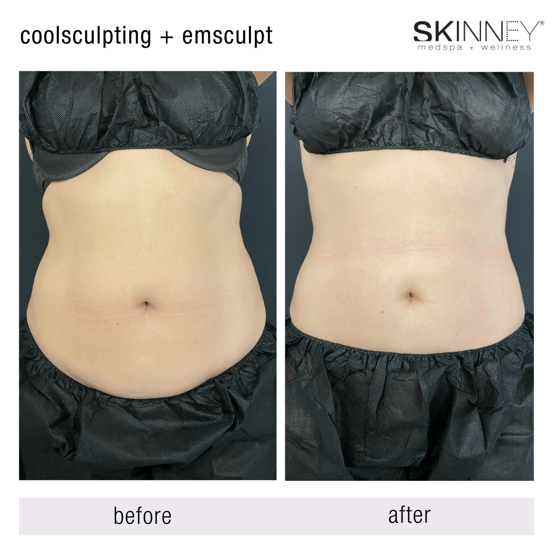 Emsculpt NEO (NYC Locations Only)