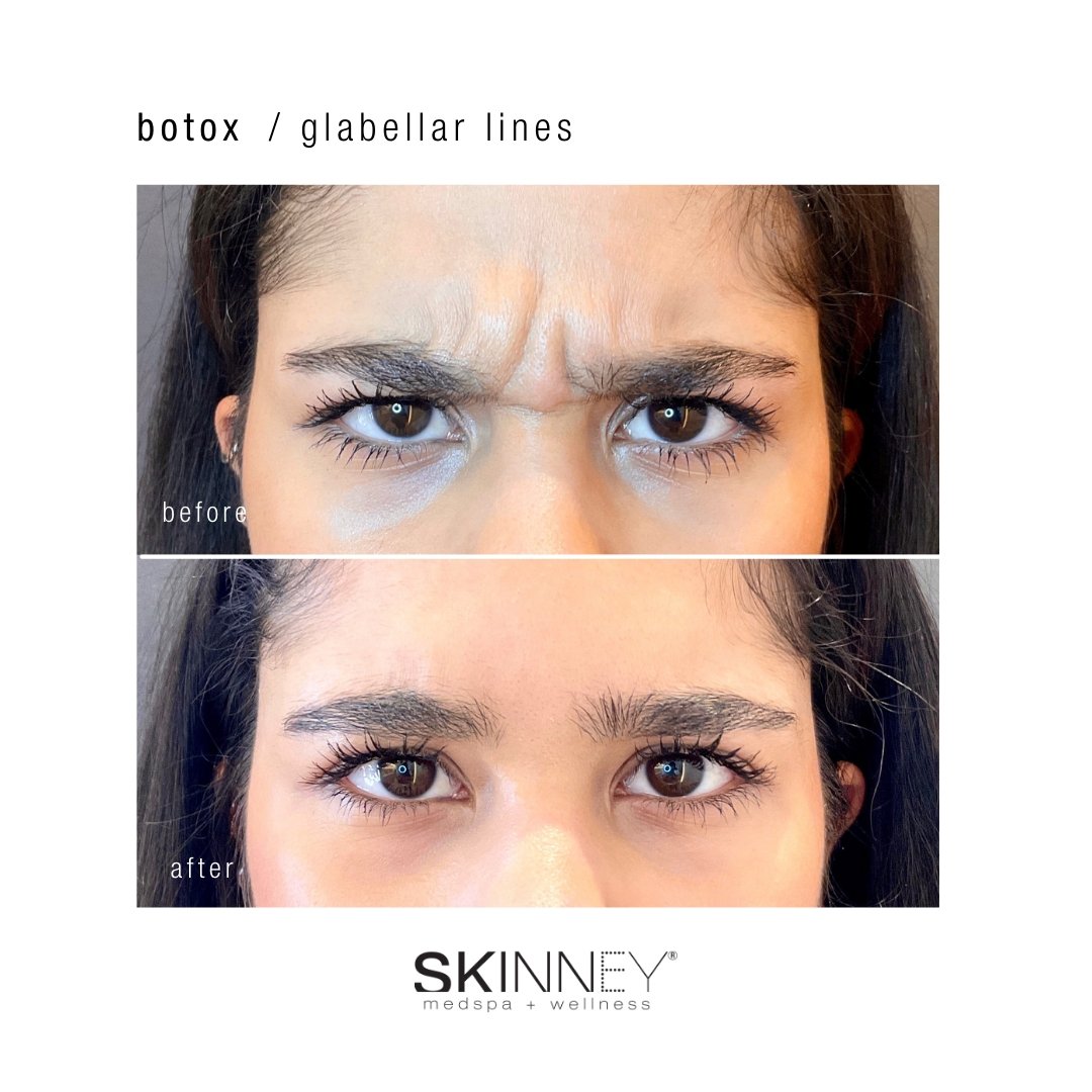 Botox - Skinney Medspa Services