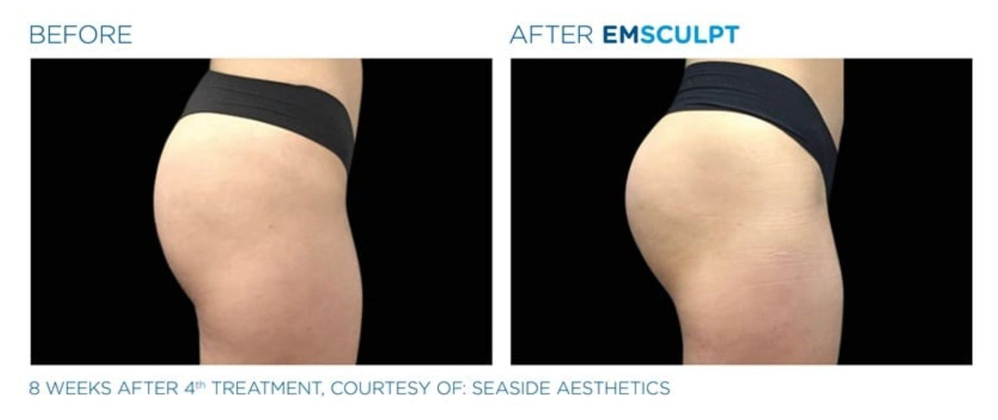 Emsculpt - Skinney Medspa Services
