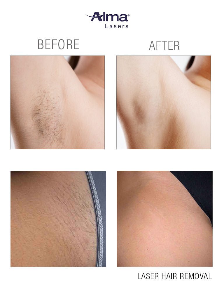 Laser Hair Removal - Skinney Medspa Services