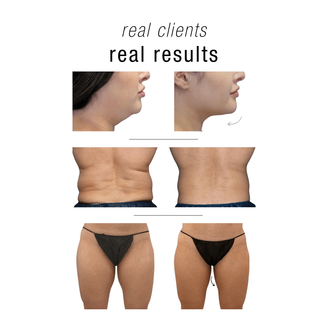 Coolsculpting