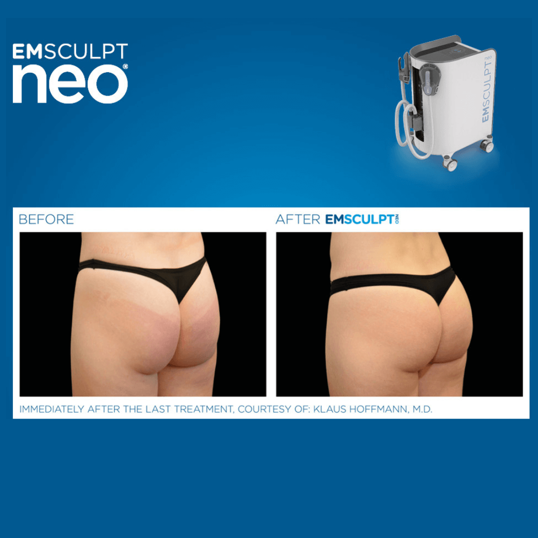 Emsculpt NEO (NYC Locations Only)