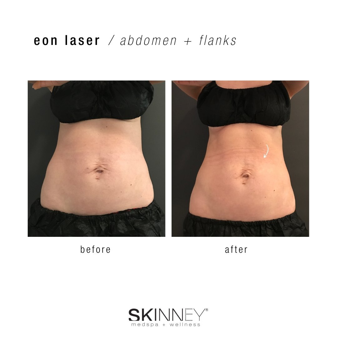 EON - SKINNEY Medspa Treatments