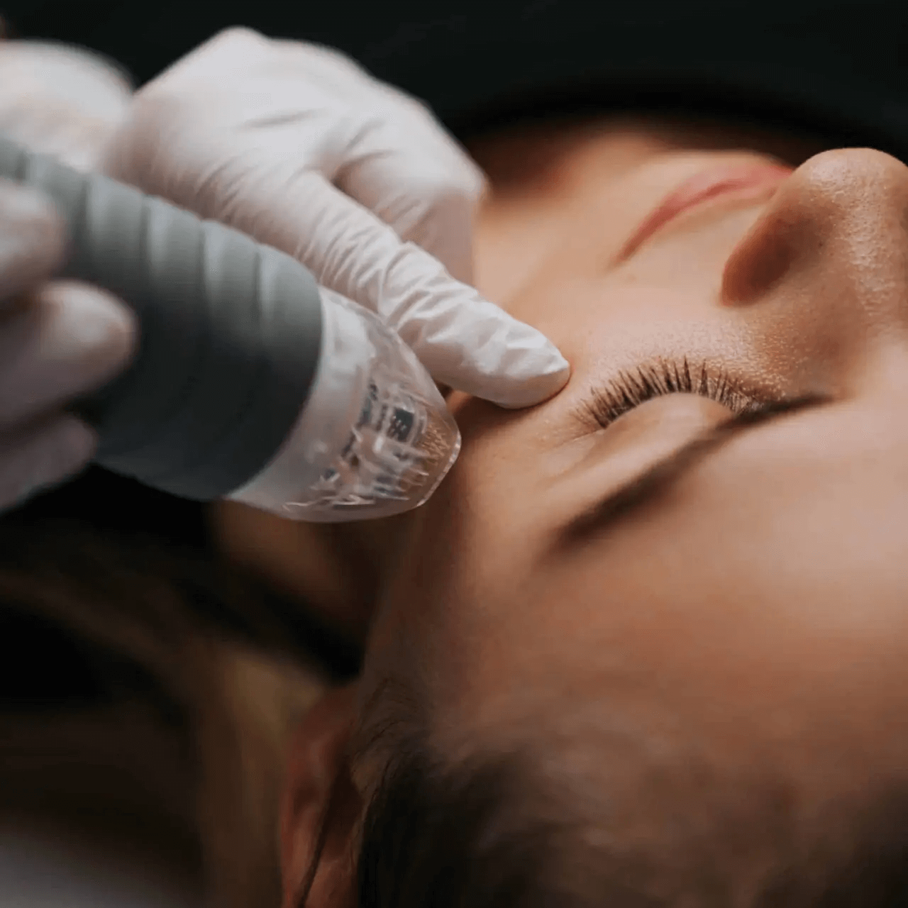 Morpheus8 (NYC Locations Only)