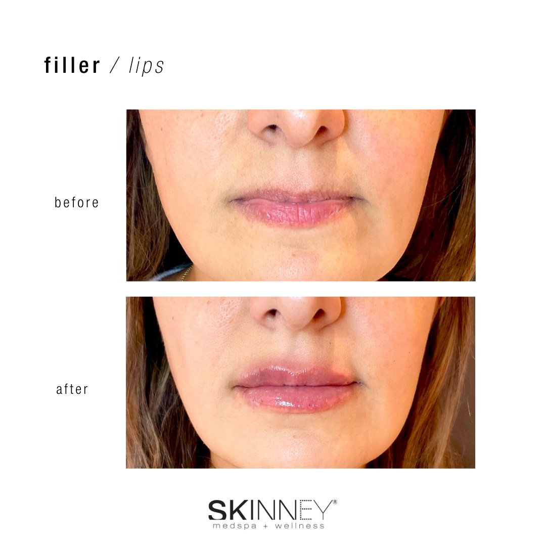 Dermal Filler - Skinney Medspa Services