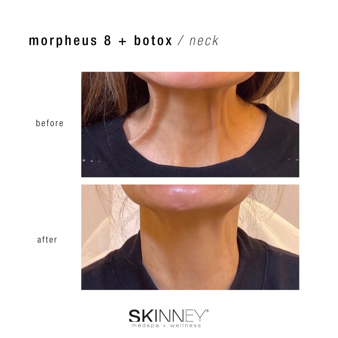 Morpheus 8 - Skinney Medspa Services