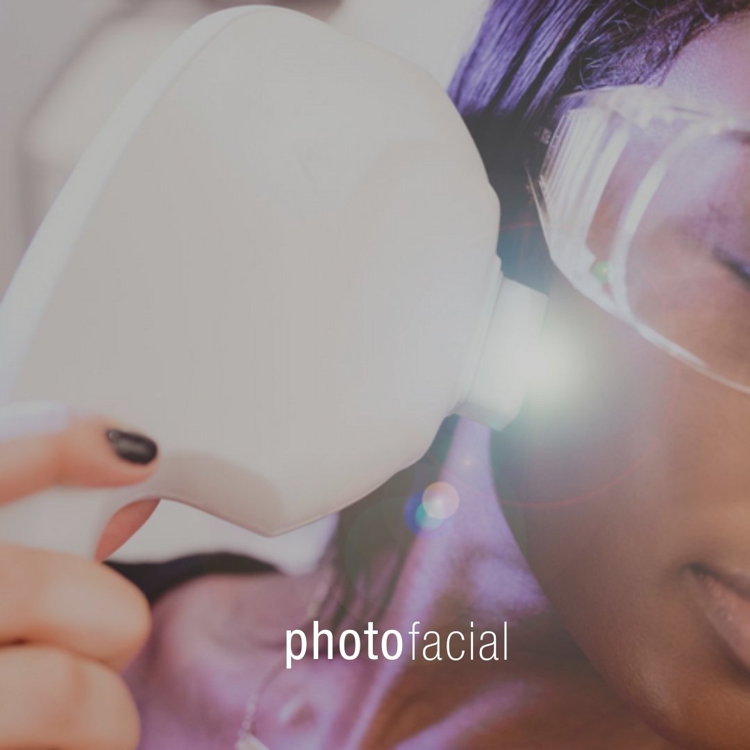 Photofacial - Skinney Medspa Services